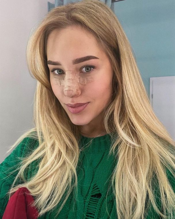 Даша Квиткова сделала ринопластику / © instagram.com/kvittkova