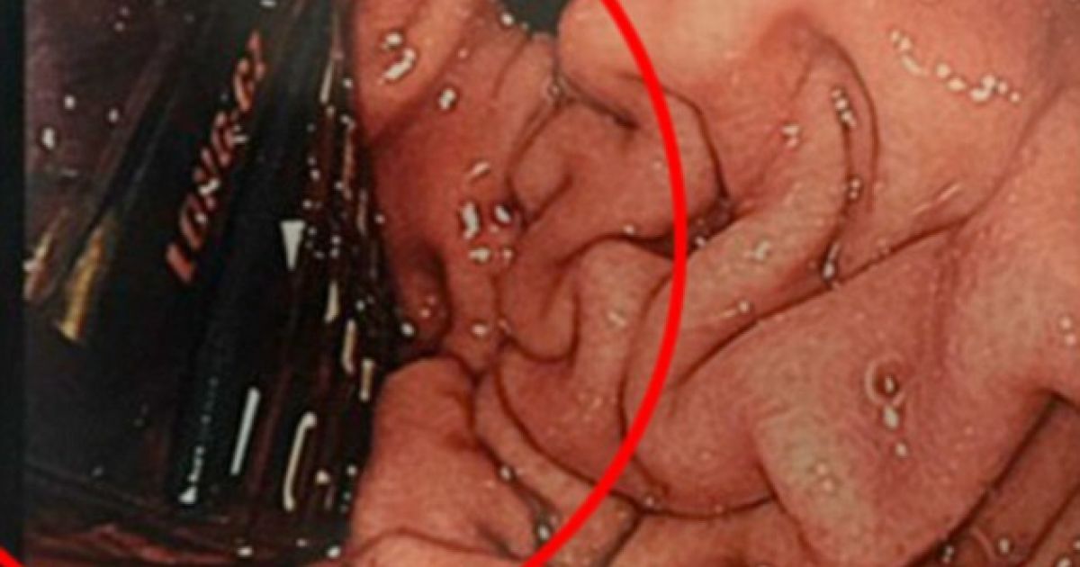 В Ирландии удивленные хирурги удалили из желудка заключенного мобильный телефон