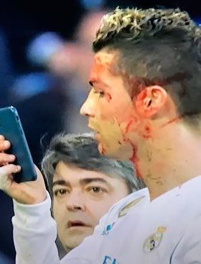 Роналду с помощью телефона решил проверить насколько у него разбито лицо