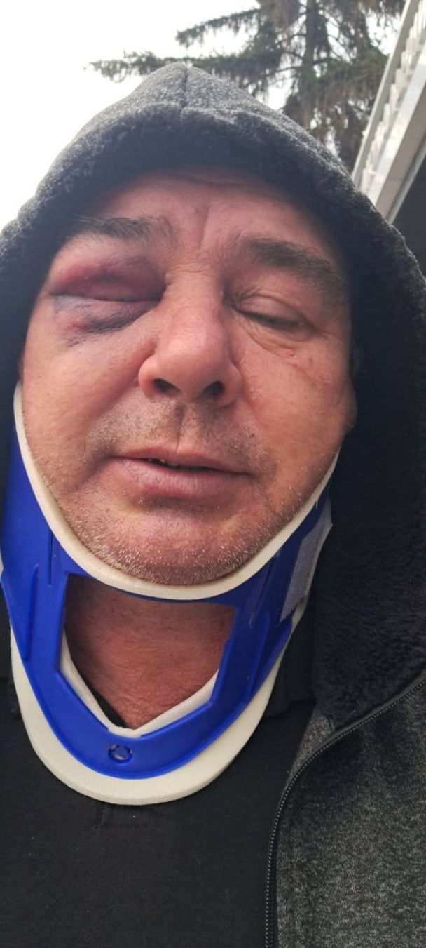 Чоловік, якого побили співробітники ТЦК на Київщині Фото/ Facebook: Вероника Кольцова / © 