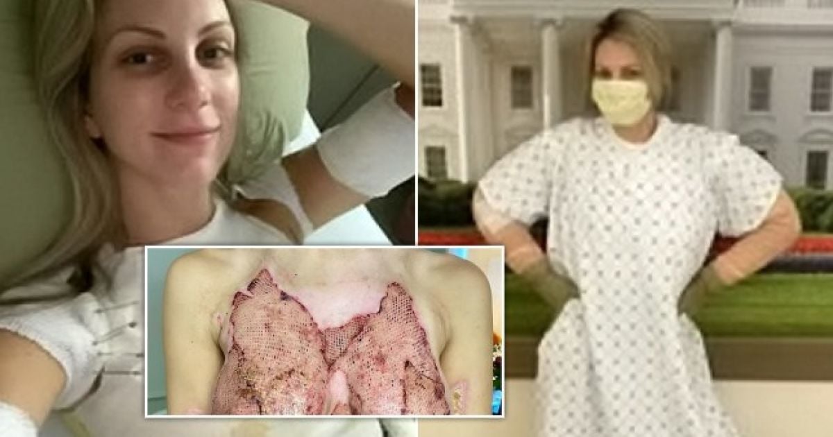 "Думала, что умру": грудь молодой девушки "растаяла" после того, как она упала на горячую кастрюлю (фото)