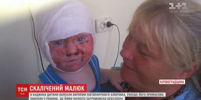На Кировоградщине в доме ребенка обожгли кипятком 1,5-летнего мальчика
