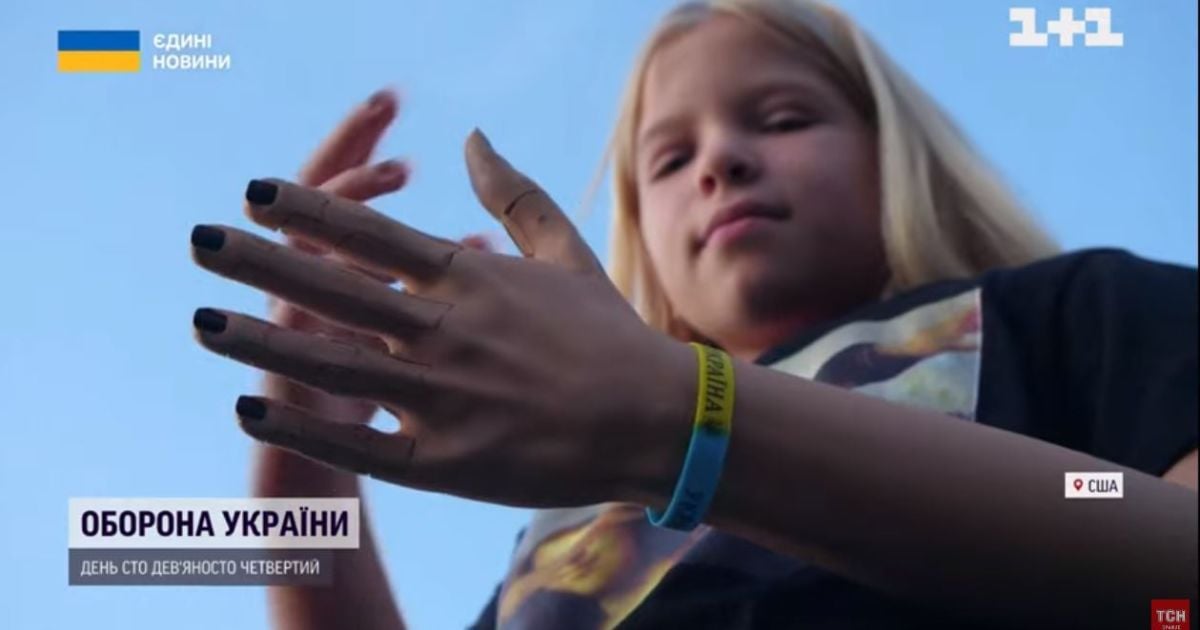 Дівчинка із Гостомеля, якій росіяни відстрелили руку, отримала в подарунок роботизований протез