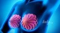 Чи можуть препарати для схуднення знижувати ризик раку молочної залози