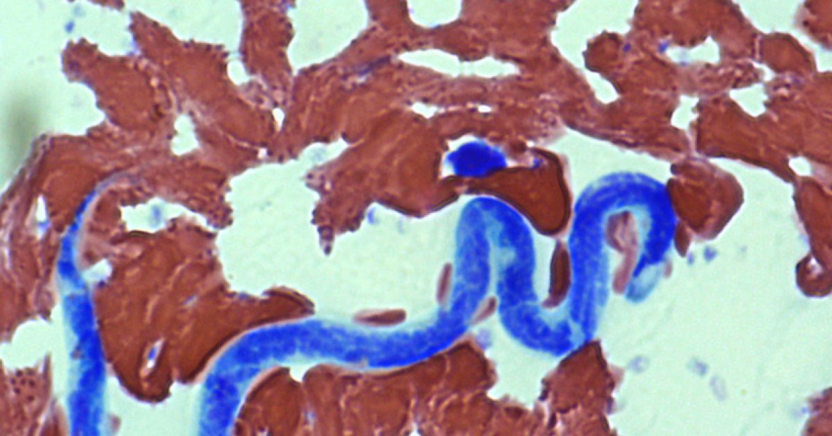 Гельминт в глазу