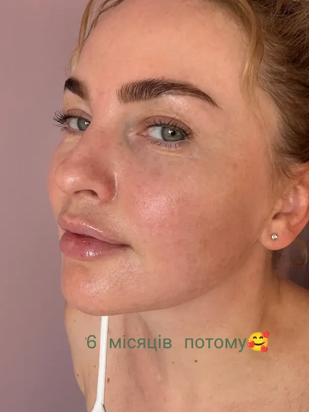 Вікторія Булітко після операції / © instagram.com/bulitka