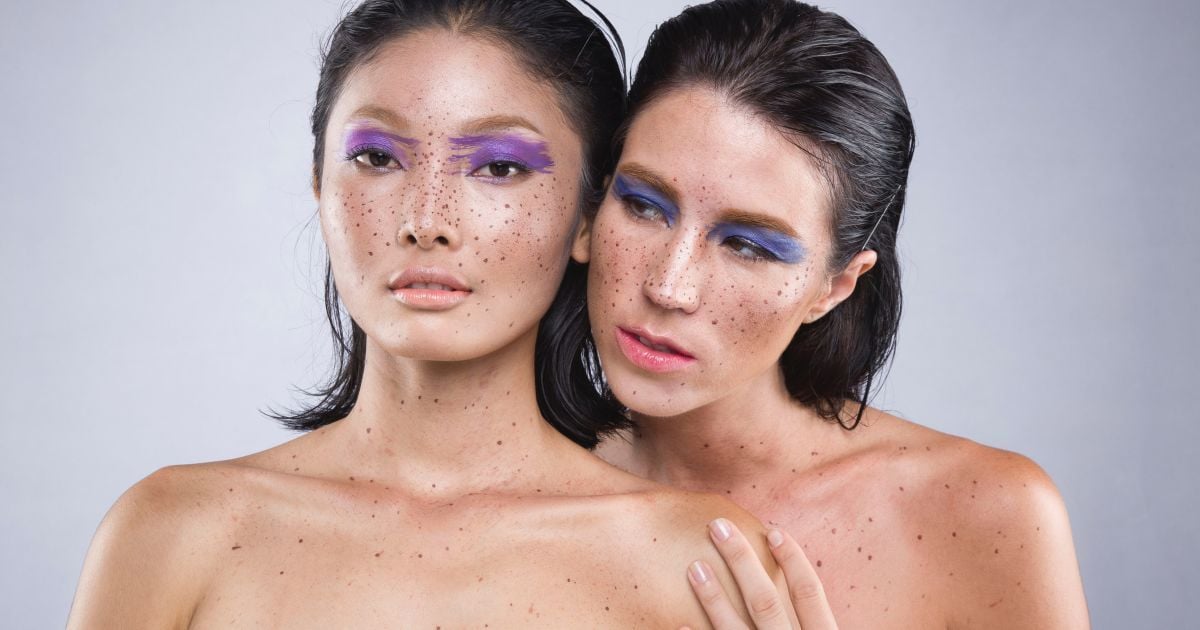 Опасные пятна: как уберечься от появления родинок