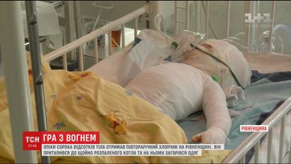 Малюк, який ледь не згорів живцем на Рівненщині, отримав опіки 40% тіла