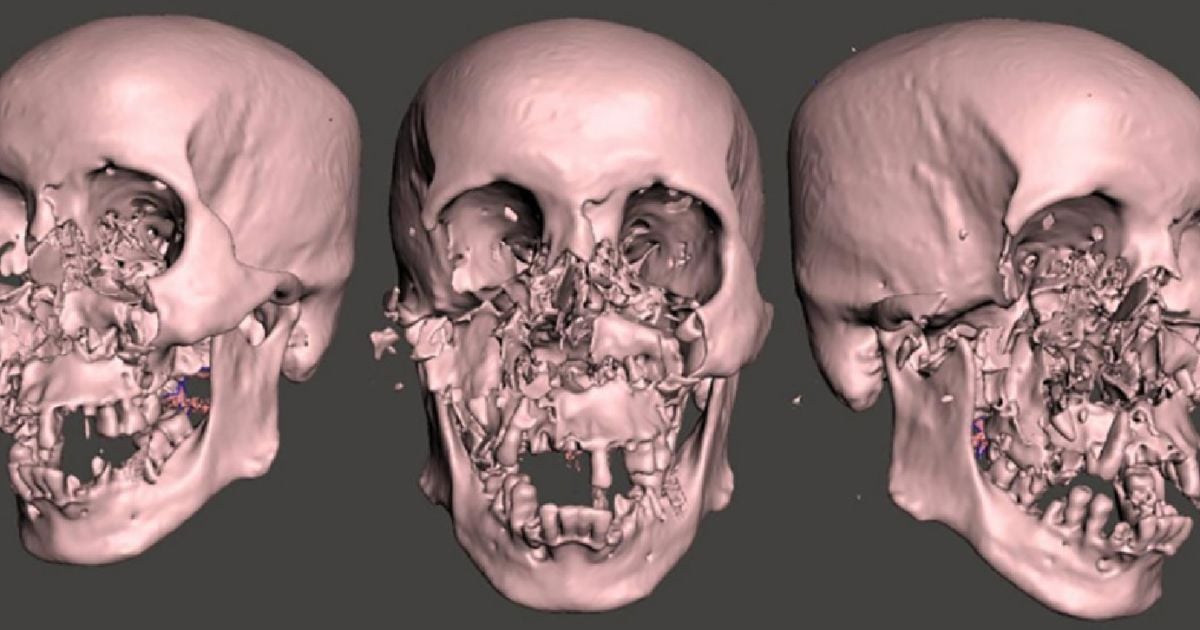 Реконструкция лица после нападения медведя / Фото: Science Direct