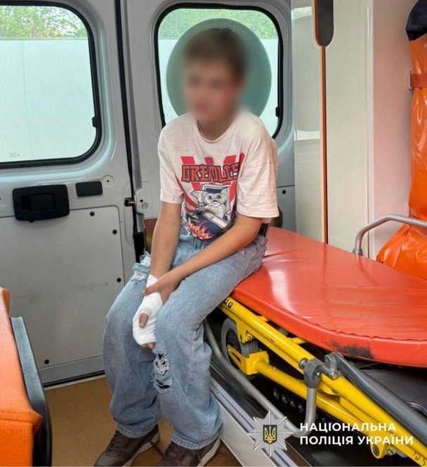 Взорвался в кармане: на Киевщине парень получил ожоги из-за неизвестного предмета с улицы (фото)