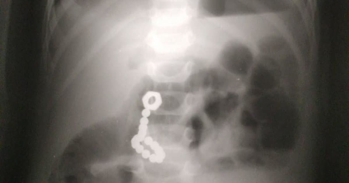 Пробыл 5 дней в реанимации: в Днепре элементы магнитного конструктора продырявили 2-летнему ребенку кишечник