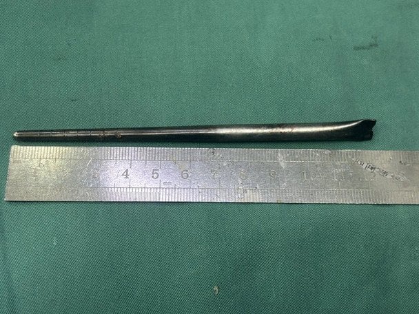 Чоловік 8 років жив із металевою паличкою в горлі / © Oddity Central