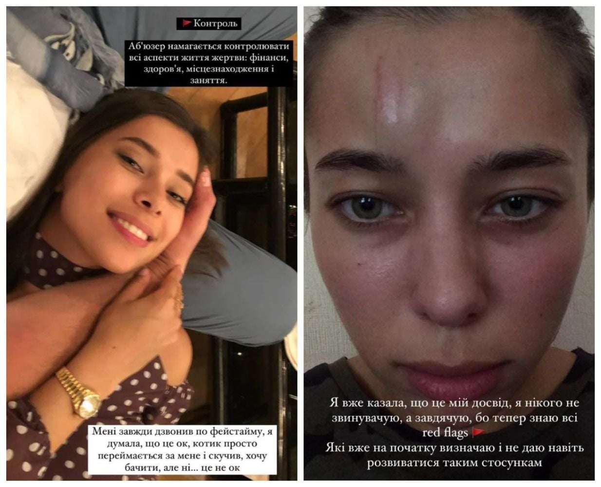 Анна Неплях показала последствия своих абьюзивных отношений / © instagram.com/neplyah