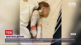 Маленький мальчик в Днепре опрокинул на себя кастрюлю с кипятком, его спасают медики