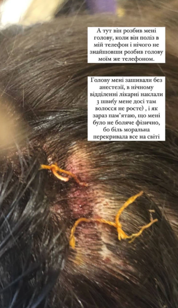 Анна Неплях показала последствия своих абьюзивных отношений / © instagram.com/neplyah