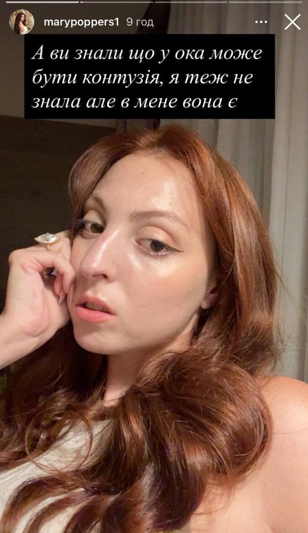 Маша Полякова після ДТП / © instagram.com/marypoppers1