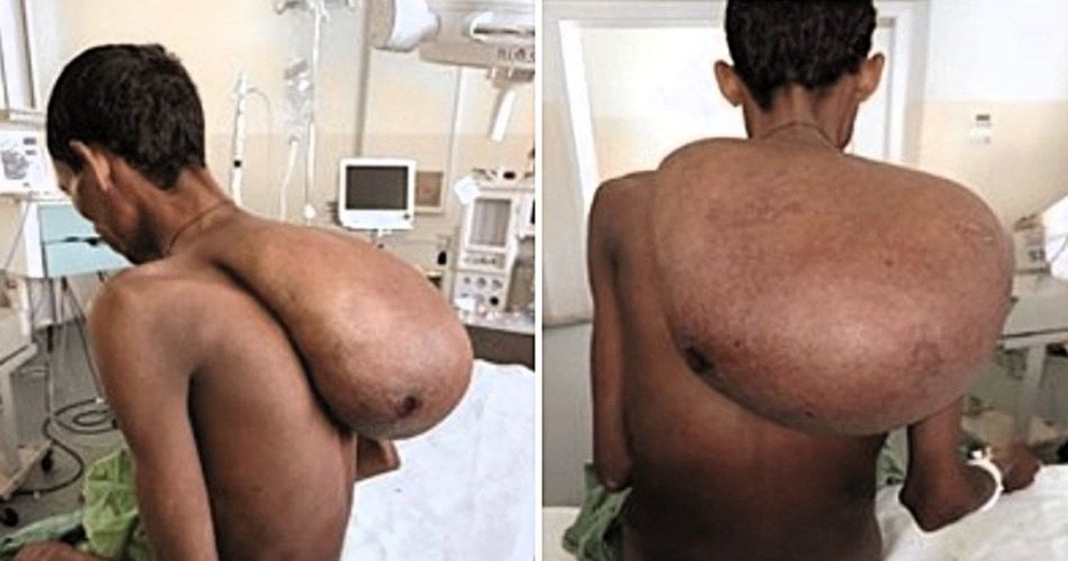 Опухоль на шее у 29-летнего фермера