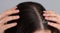 Почему чешется кожа головы