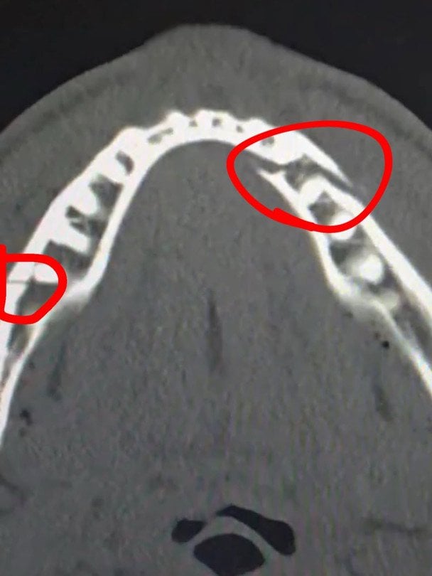 Зламана щелепа Джейка Пола / instagram.com/jakepaul