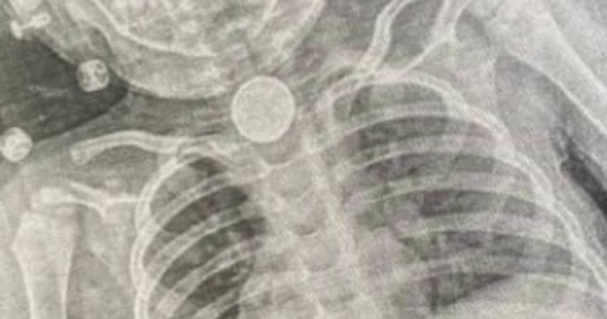 Батарейка у стравоході