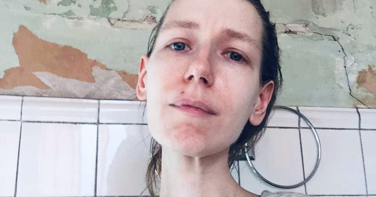 Мешканка Києва Ірина важить менше 30 кілограмів. Фото Ірини Цілик/Facebook