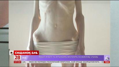 Ложка овсянки в день: как анорексия разрушила жизнь 27-летней Александры