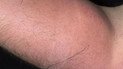 Рука пацієнта / Фото: Irish Medical Journal