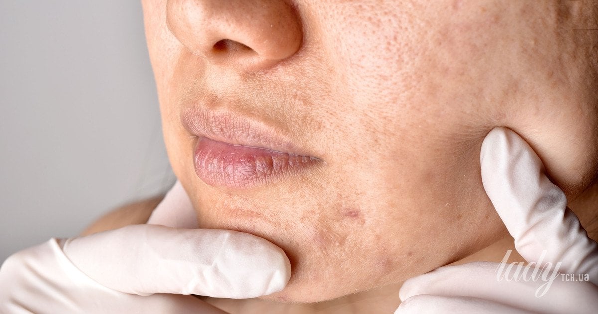 Комедон, папула, пустола та вузол: чому виникають і як лікуються різні прояви акне