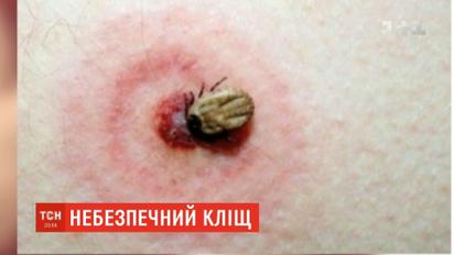 Пораженных боррелиозом украинцев после укуса клеща становится больше
