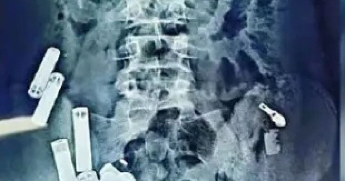 Врачи извлекли из тела мальчика 56 металлических предметов / Фото: Rare Shot News