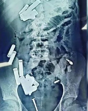 Лікарі дістали з тіла хлопчика 56 металевих предметів / Фото: Rare Shot News Лікарі дістали з тіла хлопчика 56 металевих предметів / Фото: Rare Shot News