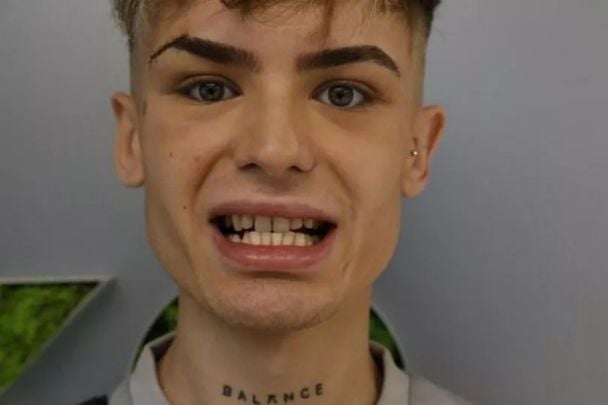 Зуби Джейка до вінірів / © dailystar.co.uk