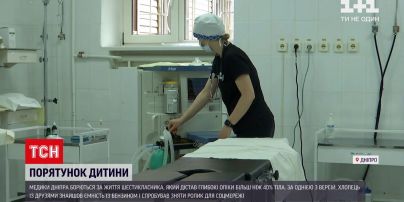 Новини України: у Дніпрі медики рятують життя 12-річного хлопчика з опіками 40% шкіри
