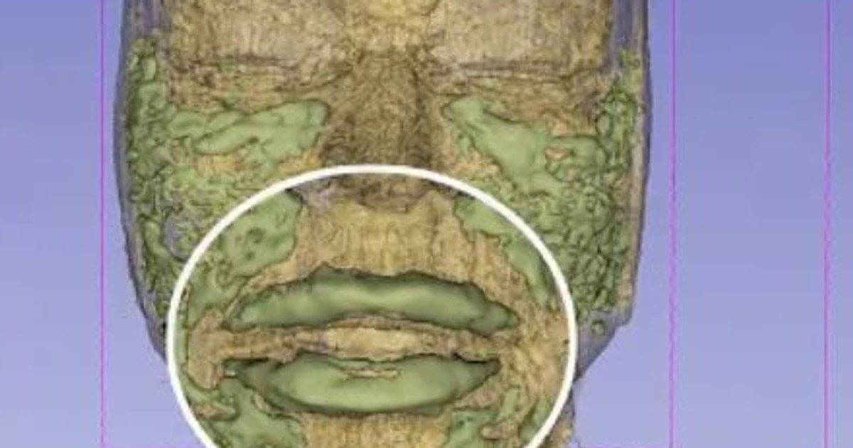 Филлеры в лице