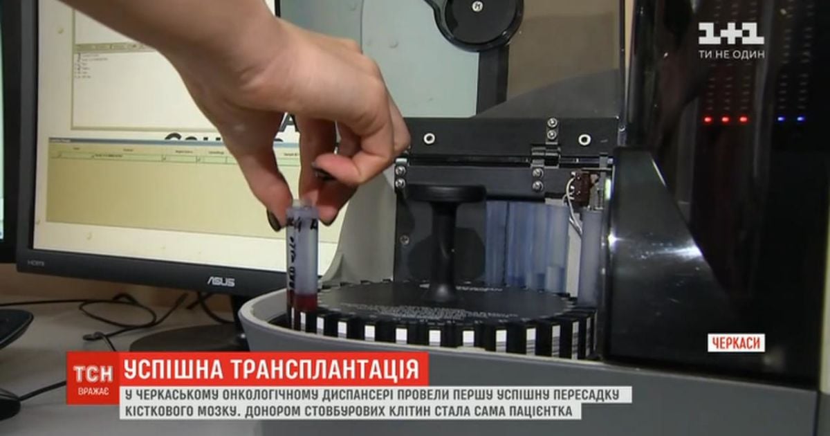 У Черкаському онкоцентрі пересадили кістковий мозок. До першої трансплантації готувалися два десятиліття