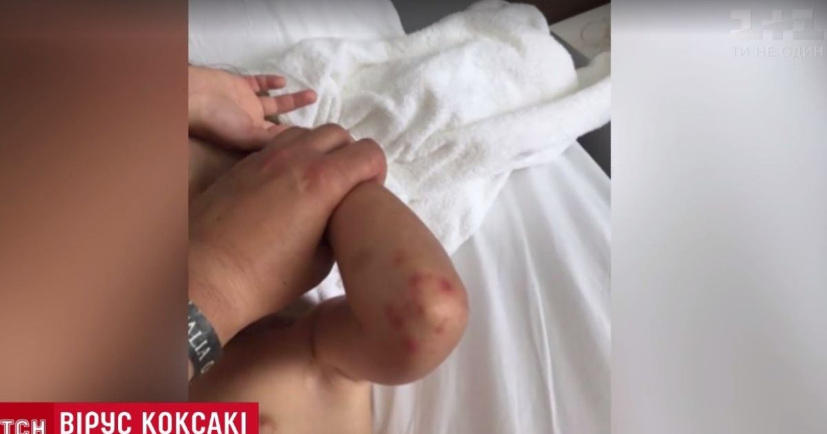 Малярія, гепатит, холера: що українці ризикують привезти з морського відпочинку