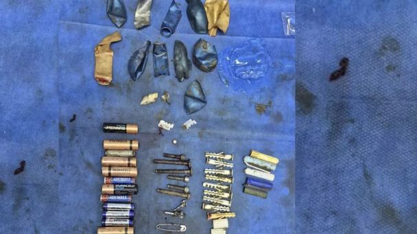 Лікарі дістали з тіла хлопчика 56 металевих предметів / Фото: Rare Shot News Лікарі дістали з тіла хлопчика 56 металевих предметів / Фото: Rare Shot News