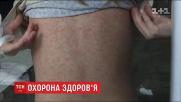 Ежедневно по человеку. В столице растет количество больных корью