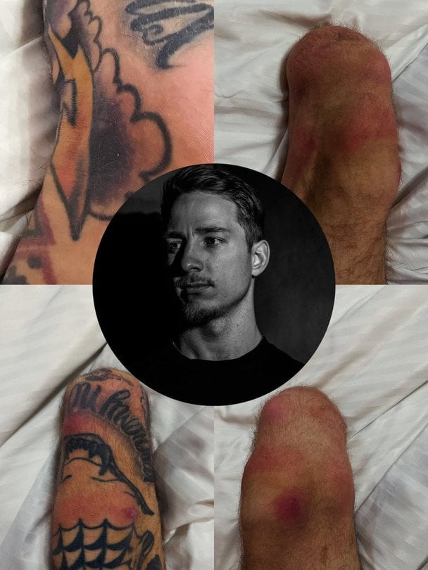 Александру Терену сказывается ношение протезов / © instagram.com/tsvit_terenu