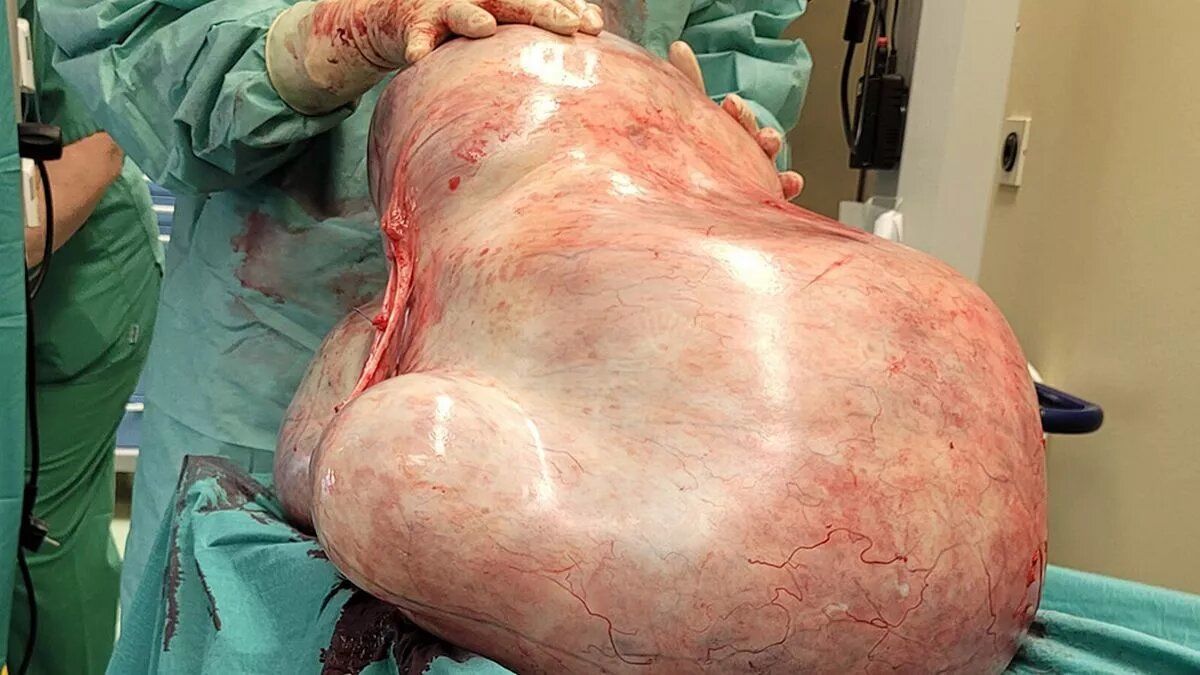 Жінці видалили пухлину вагою 32 кг / Фото: Jam Press/University Women's Hospital Magdeburg / © 