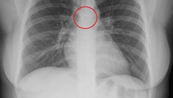 Пірсинг в легенях / &copy; скриншот з відео