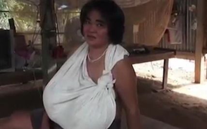 В Таиланде из-за загадочной аномалии у женщины стремительно выросла грудь