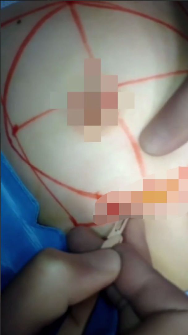 Анна Тринчер показала откровенные кадры своей операции по увеличению груди, фото 2