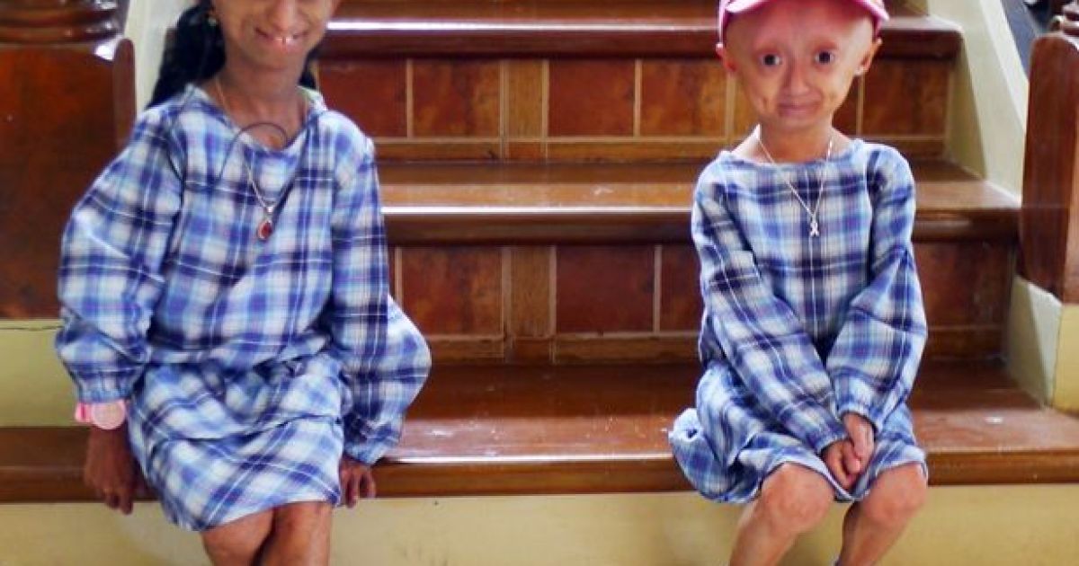 Редкая болезнь превратила девушку в бабушку