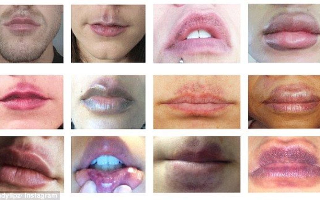 Результат використання збільшувача для губ після того, як вуста повертають собі природні розміри / © Candylipz/Instagram