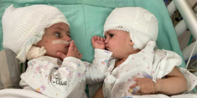 Сложнейшая операция длилась 12 часов: в Израиле успешно разъединили сиамских близнецов