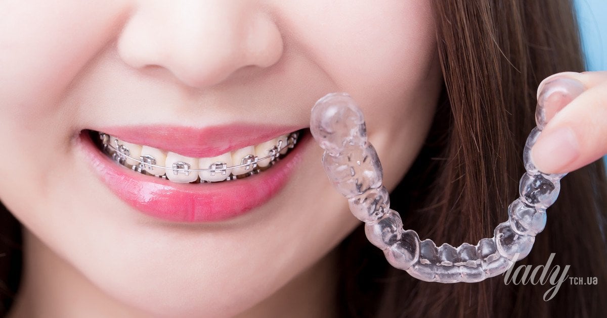 Чи можна дорослим ставити брекети та, чи варто це робити