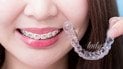 Чи можна дорослим ставити брекети та, чи варто це робити