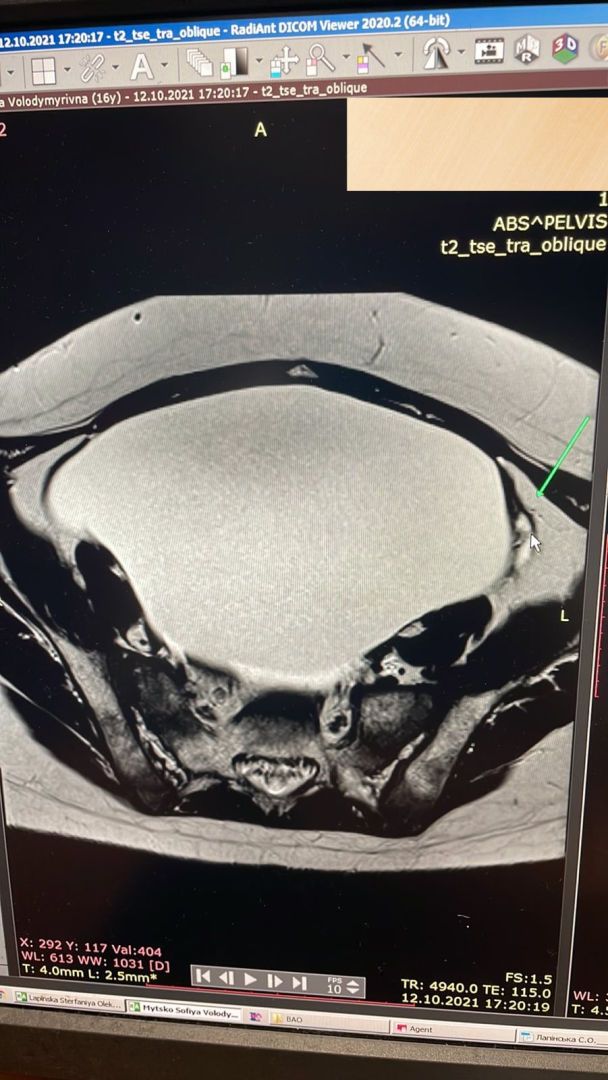 во Львове медики удалили из яичников 14-летней девушки 3-килограммовую опухоль