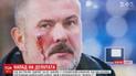 У Дніпрі під час футбольного матчу розбили обличчя нардепу Березі